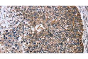 Immunohistochemistry of paraffin-embedded Human esophagus cancer using RASSF7 Polyclonal Antibody at dilution of 1:45 (RASSF7 anticorps)