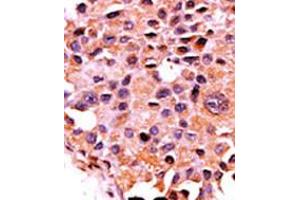 Formalin-fixed and paraffin-embedded human cancer tissue reacted with the primary antibody, which was peroxidase-conjugated to the secondary antibody, followed by AEC staining.