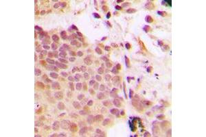 Immunohistochemical analysis of G3BP1 (pS232) staining in human breast cancer formalin fixed paraffin embedded tissue section.
