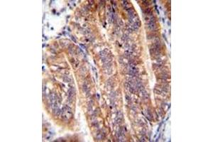 Immunohistochemistry analysis in formalin fixed and paraffin embedded human uterus tissue reacted with NUMB Antibody (N-term) followed by peroxidase conjugation of the secondary antibody and DAB staining. (NUMB anticorps  (N-Term))