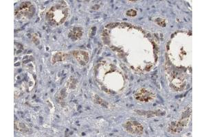 1/50 dilution staining Caspase 9 in human lung carcinoma by Immunohistochemistry (Caspase 9 anticorps  (Cleaved-Asp330))