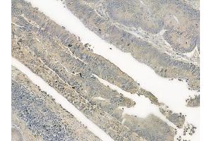 ABIN6266184 and ABIN6277405 at 1/100 staining human colon carcinoma by IHC-P.