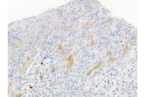 ABIN6255507 and ABIN6267620 at 1/100 staining human tongue carcinoma by IHC-P.