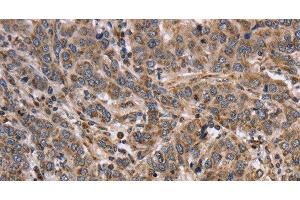 Immunohistochemistry of paraffin-embedded Human liver cancer tissue using EPOR Polyclonal Antibody at dilution 1:40 (EPOR anticorps)