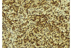 ABIN6274198 at 1/100 staining Human breast cancer tissue by IHC-P.