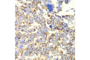 Immunohistochemistry of paraffin-embedded human esophageal cancer using GLUD2 antibody.