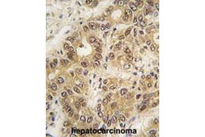 Formalin-fixed and paraffin-embedded human hepatocellular carcinoma tissue reacted with ZIC3 polyclonal antibody , which was peroxidase-conjugated to the secondary antibody, followed by DAB staining. (ZIC3 anticorps  (N-Term))
