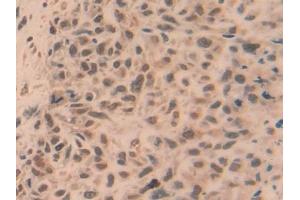 Detection of TRAF5 in Human Lung cancer Tissue using Polyclonal Antibody to TNF Receptor Associated Factor 5 (TRAF5) (TRAF5 anticorps  (AA 181-437))