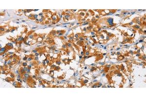 Immunohistochemistry of paraffin-embedded Human thyroid cancer using DKK3 Polyclonal Antibody at dilution of 1:50 (DKK3 anticorps)