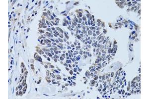 Immunohistochemistry of paraffin-embedded human lung cancer using SIN3A antibody (ABIN6293567) at dilution of 1:100 (40x lens). (SIN3A anticorps)
