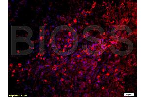 Formalin-fixed and paraffin embedded: Human laryngeal carcinoma labeled with Anti-C5a Polyclonal Antibody (ABIN727875), Unconjugated at 1:200, followed by conjugation to the secondary antibody was Goat Anti-Rabbit IgG, PE conjugated at 1:200 for 40 minutes at 37°C
