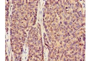 Immunohistochemistry of paraffin-embedded human ovarian cancer using ABIN7170002 at dilution of 1:100