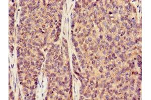 Immunohistochemistry of paraffin-embedded human ovarian cancer using ABIN7170002 at dilution of 1:100 (GLUT1 anticorps  (AA 263-458))