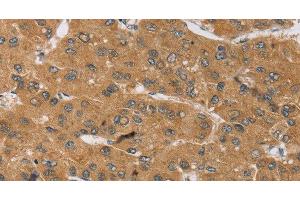 Immunohistochemistry of paraffin-embedded Human liver cancer tissue using KCNJ15 Polyclonal Antibody at dilution 1:40 (KCNJ15 anticorps)