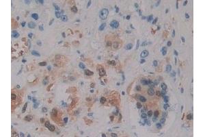 Detection of SDH in Human Prostate cancer Tissue using Polyclonal Antibody to Sorbitol Dehydrogenase (SDH)