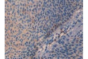Detection of Slit3 in Human Skin cancer Tissue using Polyclonal Antibody to Slit Homolog 3 (Slit3) (SLIT3 anticorps  (AA 1405-1512))