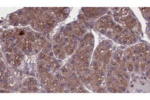 ABIN6273973 at 1/100 staining Human liver cancer tissue by IHC-P. (OR1L3 anticorps  (C-Term))