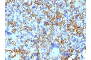 Formalin-fixed, paraffin-embedded human Histiocytoma stained with HLA-DR Monoclonal Antibody (LN-3). (HLA-DRB1 anticorps)