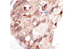 IHC analysis of FFPE human breast carcinoma tissue stained with the SUV39H2 antibody