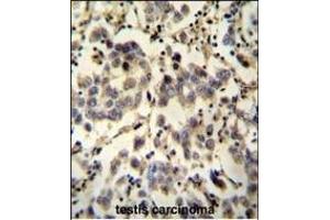 C6orf58 antibody (Center) (ABIN653979 and ABIN2843925) immunohistochemistry analysis in formalin fixed and paraffin embedded human testis carcinoma followed by peroxidase conjugation of the secondary antibody and DAB staining. (C6ORF58 anticorps  (AA 205-233))