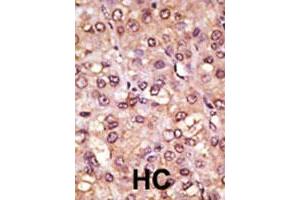 Formalin-fixed and paraffin-embedded human hepatocellular carcinoma tissue reacted with ASCL1 polyclonal antibody , which was peroxidase-conjugated to the secondary antibody, followed by AEC staining. (ASCL1 anticorps  (C-Term))