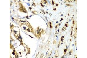 Immunohistochemistry of paraffin-embedded Human liver cancer using TMOD4 Polyclonal Antibody at dilution of 1:100 (40x lens). (Tropomodulin 4 anticorps)