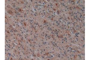 Detection of PLAP in Human Glioma Tissue using Polyclonal Antibody to Phospholipase A2 Activating Protein (PLAP)