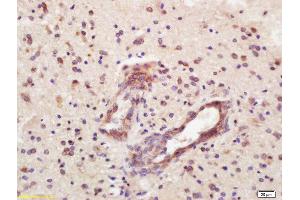 Formalin-fixed and paraffin embedded human glioma labeled with Rabbit Anti-CD32 Polyclonal Antibody, Unconjugated  at 1:200 followed by conjugation to the secondary antibody and DAB staining (Fc gamma RII (CD32) (AA 201-300) anticorps)