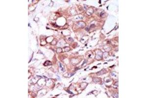 Formalin-fixed and paraffin-embedded human cancer tissue reacted with the primary antibody, which was peroxidase-conjugated to the secondary antibody, followed by DAB staining. (ERBB4 anticorps  (C-Term))