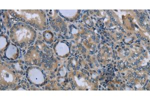 Immunohistochemistry of paraffin-embedded Human thyroid cancer tissue using EGFL8 Polyclonal Antibody at dilution 1:40 (EGFL8 anticorps)