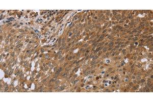 Immunohistochemistry of paraffin-embedded Human cervical cancer using NDUFS2 Polyclonal Antibody at dilution of 1:35 (NDUFS2 anticorps)