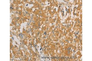 Immunohistochemistry of Human liver cancer using PRPSAP1 Polyclonal Antibody at dilution of 1:80