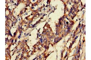 Immunohistochemistry of paraffin-embedded human gastric cancer using ABIN7153675 at dilution of 1:100 (Gastrin-Releasing Peptide anticorps  (AA 31-98))