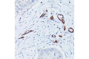 Immunohistochemistry of paraffin-embedded human lung cancer using CD34 Rabbit pAb (ABIN6134661, ABIN6138169, ABIN6138171 and ABIN6218103) at dilution of 1:100 (40x lens).