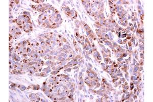 IHC-P Image PDCD6 antibody detects PDCD6 protein at cytoplasm on human colon carcinoma by immunohistochemical analysis. (PDCD6 anticorps)