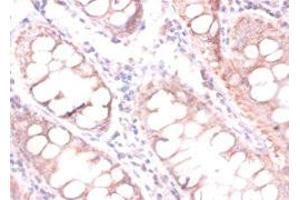 Immunohistochemistry of paraffin-embedded human colon cancer using ABIN7147238 at dilution of 1:100 (CDKN2AIPNL anticorps  (N-Term))
