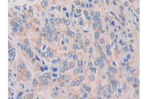 DAB staining on IHC-P; Samples: Human Prostate cancer Tissue