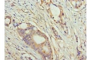 Immunohistochemistry of paraffin-embedded human colon cancer using ABIN7159633 at dilution of 1:100 (TET1 anticorps  (AA 1700-1800))