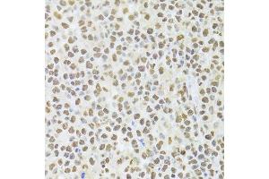 Immunohistochemistry of paraffin-embedded human B cell lymphoma using ANP32A Antibody.