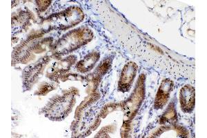 IHC analysis of ETV6/Tel using anti-ETV6/Tel antibody .