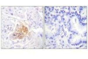 Immunohistochemistry analysis of paraffin-embedded human lung carcinoma tissue using IL-2Rβ/CD122 (Ab-364) antibody.