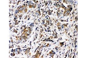 IHC-P: TRPV2 antibody testing of human intestine cancer tissue (TRPV2 anticorps  (AA 42-624))