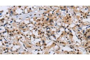 Immunohistochemistry of paraffin-embedded Human thyroid cancer tissue using KPNB1 Polyclonal Antibody at dilution 1:40 (KPNB1 anticorps)