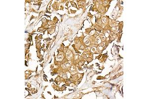 Immunohistochemistry of paraffin-embedded human breast cancer using β-Catenin Rabbit mAb (ABIN7266138) at dilution of 1:50 (40x lens).