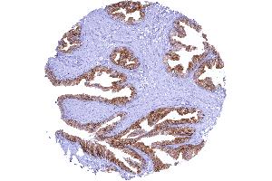 Strong membranous CD38 staining of prostatic epithelial cells