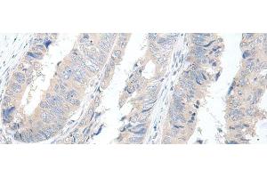 Immunohistochemistry of paraffin-embedded Human colorectal cancer tissue using GBA2 Polyclonal Antibody at dilution of 1:55(x200) (GBA2 anticorps)