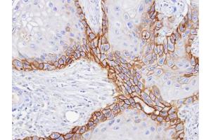IHC-P Image Immunohistochemical analysis of paraffin-embedded SCC15 xenograft, using CD98, antibody at 1:100 dilution. (SLC3A2 anticorps)