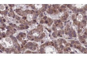 ABIN6273910 at 1/100 staining Human liver cancer tissue by IHC-P. (SSTR5 anticorps  (Internal Region))