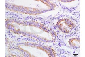 Formalin-fixed and paraffin embedded human colon carcinoma labeled with Anti SLC4A7/NBCN1 Polyclonal Antibody, Unconjugated (ABIN687847) at 1:200 followed by conjugation to the secondary antibody and DAB staining