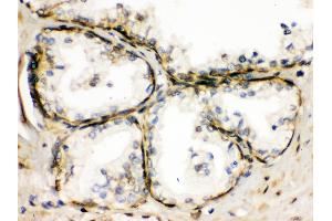 TRPM5 was detected in paraffin-embedded sections of human prostatic cancer tissues using rabbit anti- TRPM5 Antigen Affinity purified polyclonal antibody at 1 μg/mL.